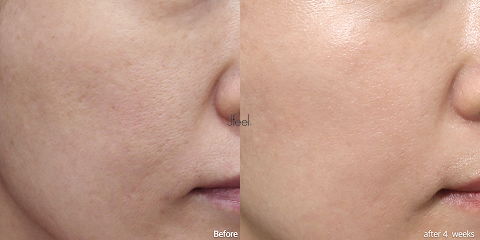 Advanced Korean facial treatment improving skin texture and pores after personalized skin analysis and clinical Korean skincare solutions