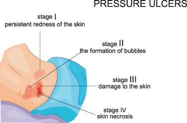 Infografica sulle ulcere da pressione