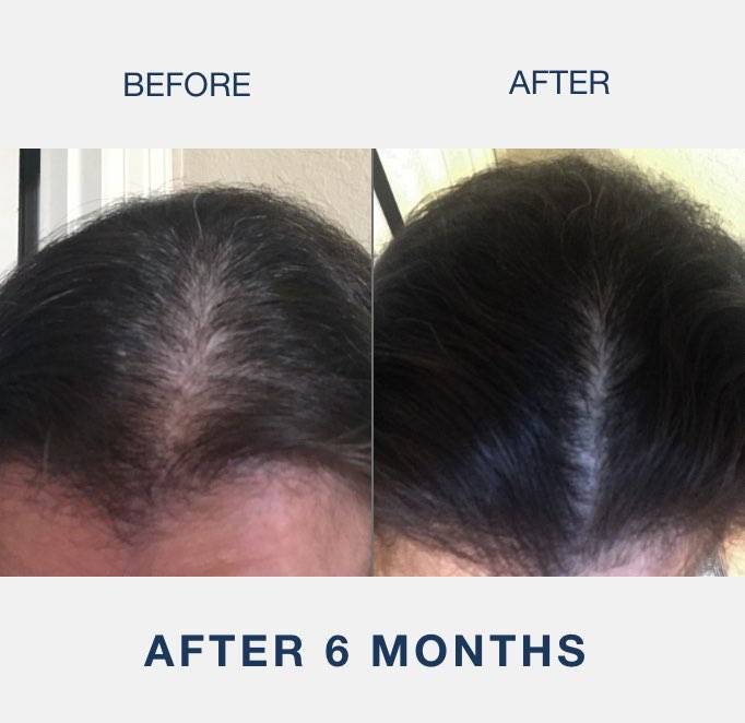 laser cap results picture after woman used illumiflow 272 pro