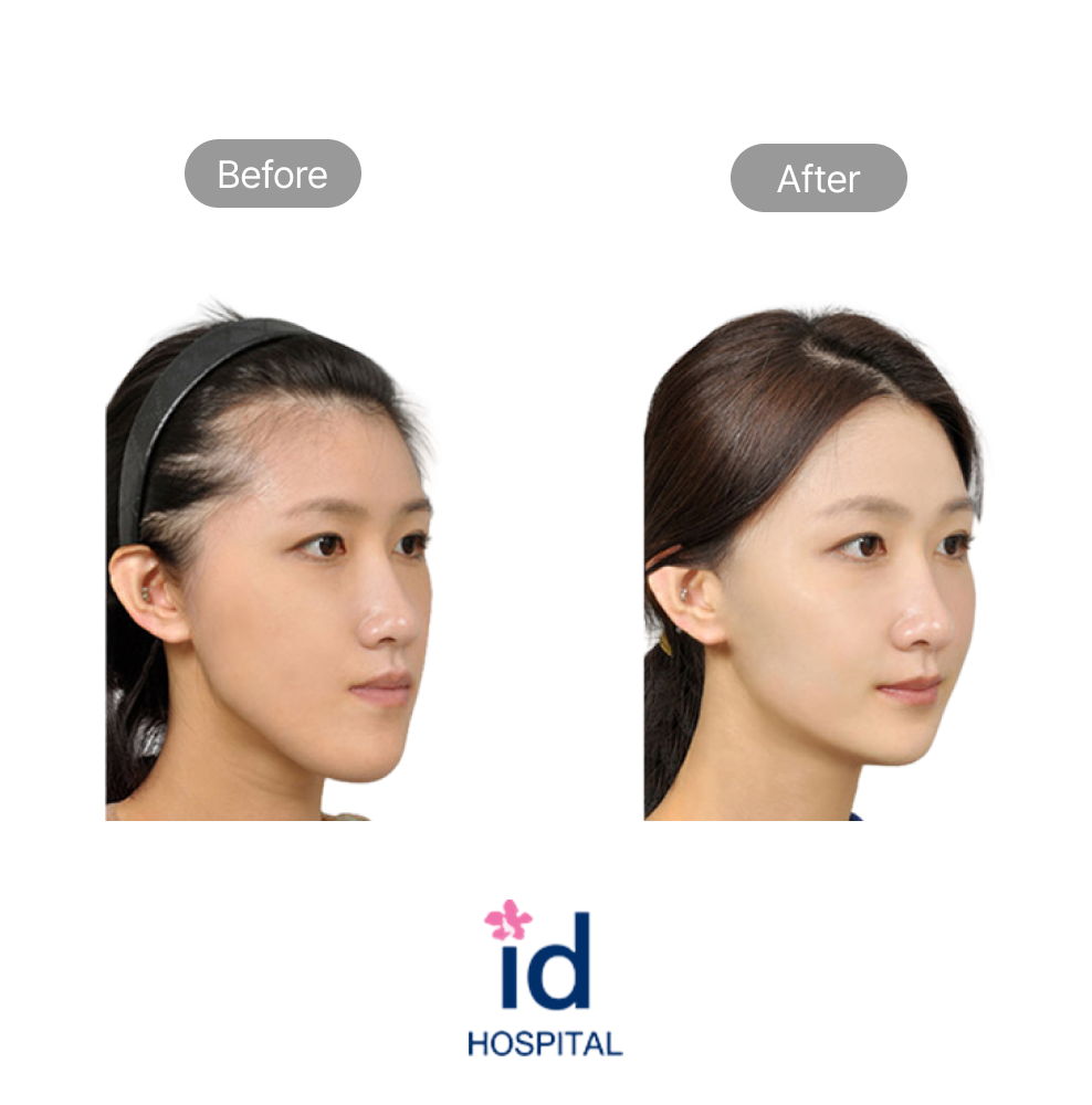 Korean No-Tie Double Jaw Surgery Before and After Result at ID Hospital