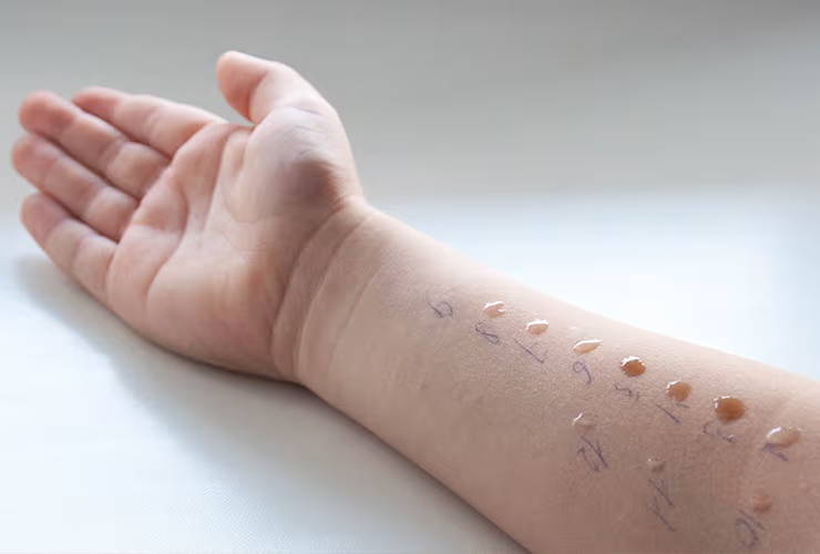 Der Arm eines Kindes während des Prick-Tests – die Tropfen einer allergenhaltigen Flüssigkeit können Reaktionen hervorrufen, die Mückenstichen ähneln