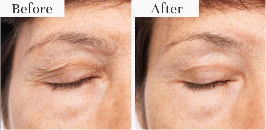 Before and after images showing eyelid appearance improvement.