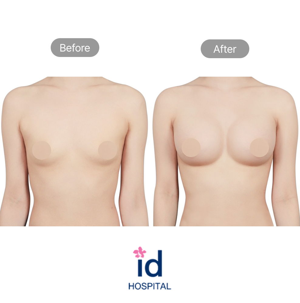 Mentor Boost Breast Augmentation Before and After Result at ID Hospital