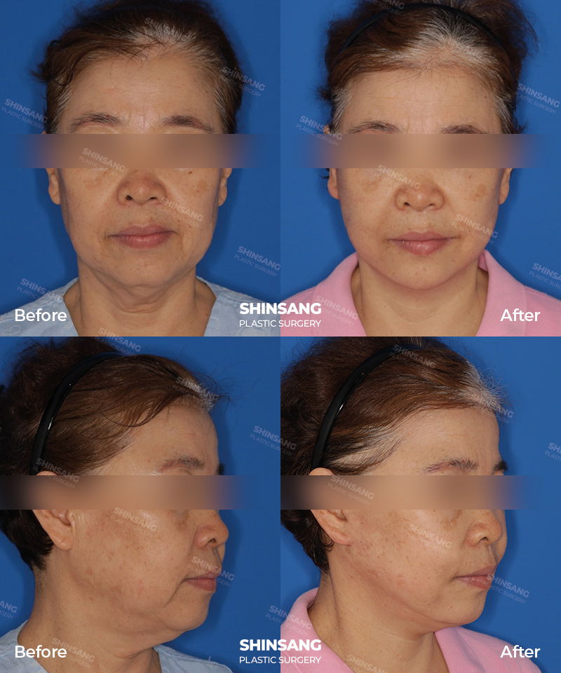 Full Facelift Patient Result At Sinsang Plastic Surgery In Korea