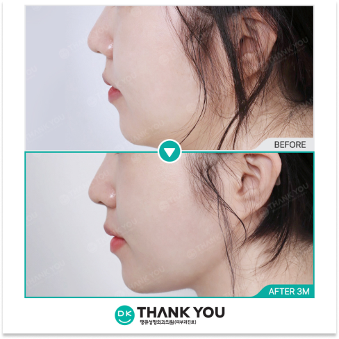 Before and after results of sagging skin treatment with Ultherapy and InMode FX showing visible lifting after 3 months
