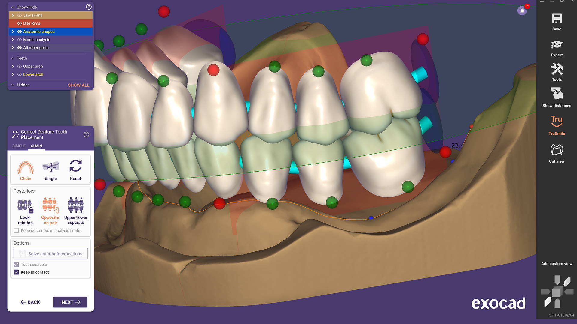 Module prothèse complete exocad
