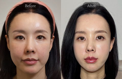 Mid and Lower Face Lift Using Threads Before and After – Jawline Thread Lift in Korea by Jivaka Beauty