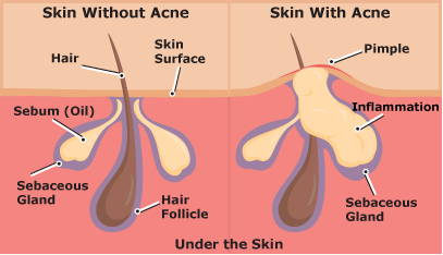 Why do I have Acne? Unraveling Causes, Treatments, and Prevention | Platinum Skin Care