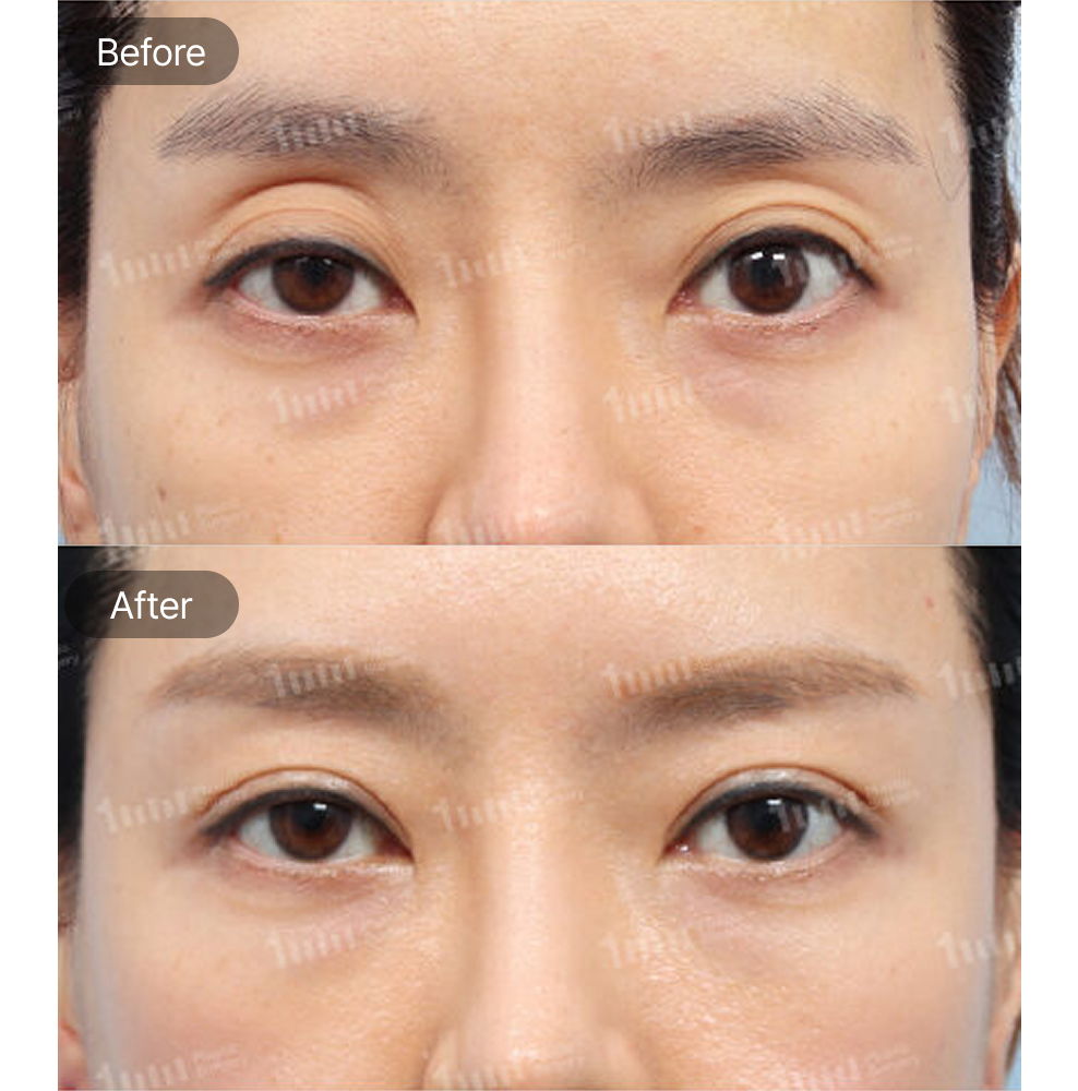 Ptosis Correction Before and After Results at 1MM Plastic Surgery in Korea for Brighter and More Defined Eyes