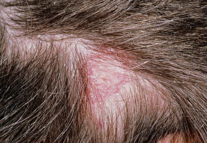 Seborrheic Dermatitis Scalp