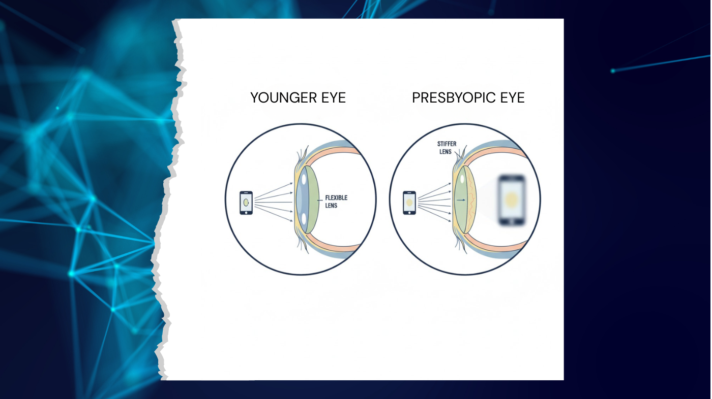 Diagram explaining what presbyopia is and how age-related lens stiffening affects near vision.