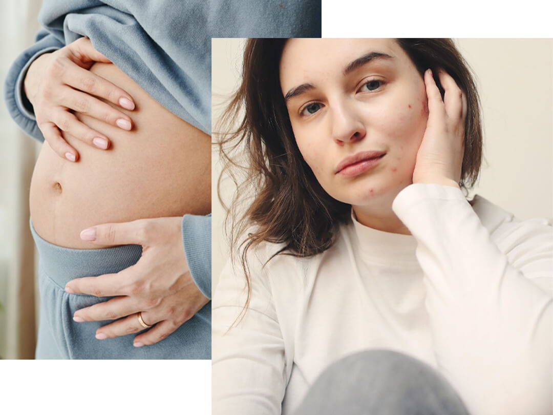 Pickel Schwangerschaft | Five Skincare 