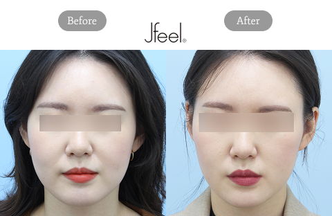 Mint Thread Face Lift Using Threads Before and After – Jawline Thread Lift in Korea by Jivaka Beauty