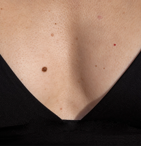 Skin Deep Mole Removal October Specials