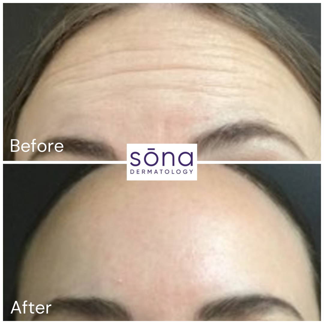 Sona - Botox Cosmetic Before & After 15
