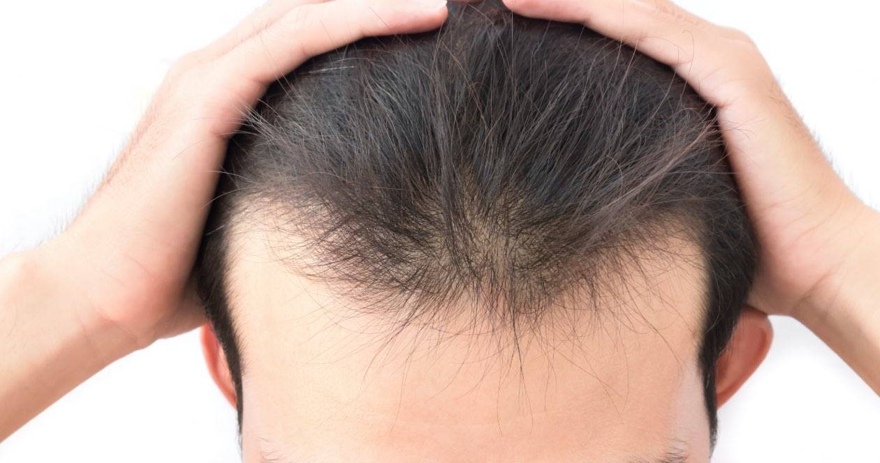 close up of man pulling hair back to show hair loss