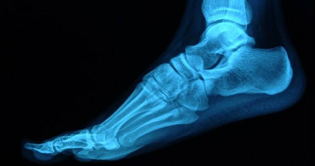 Think You May Have A Stress Fracture? Premier Foot & Ankle Center