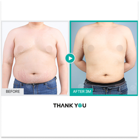 Gynecomastia surgery in Korea Before and After