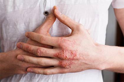 Un'immagine di mani con eczema