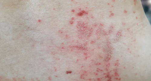 Scattered dark red marks on pale skin – this is milaria or heat rash, also known as prickly heat