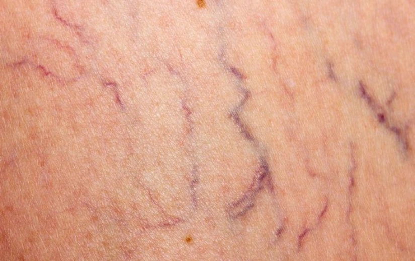 Spider Veins