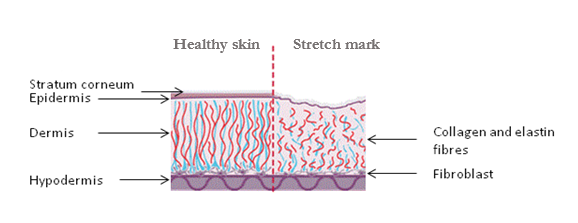 Stretch mark cream 