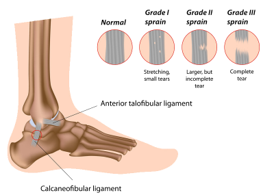 Ankle Sprain Diagram