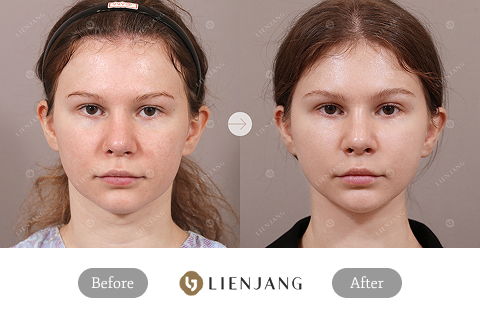 Before and after results of V-line liposuction, thread lift, and Ultherapy in Korea showing facial contouring improvement after professional consultation and treatment
