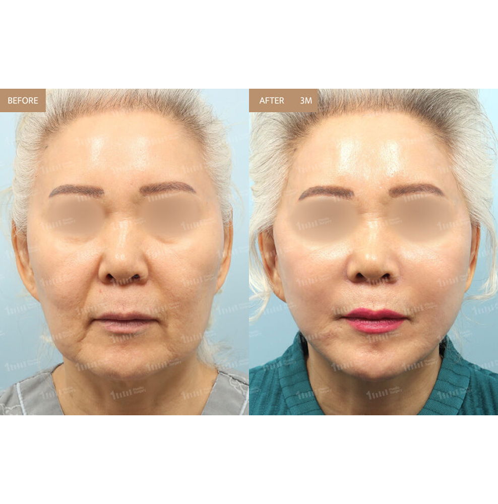Mini Facelift Before and After Results at 1MM Plastic Surgery in Korea for Lifted and More Youthful Facial Contours