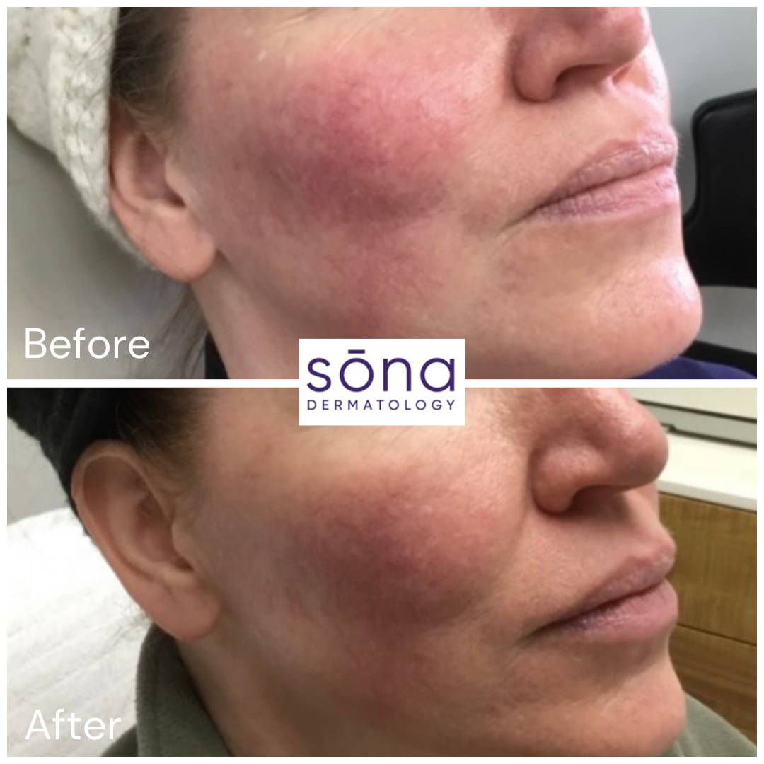Sona Motus AY Laser Facial Before and After