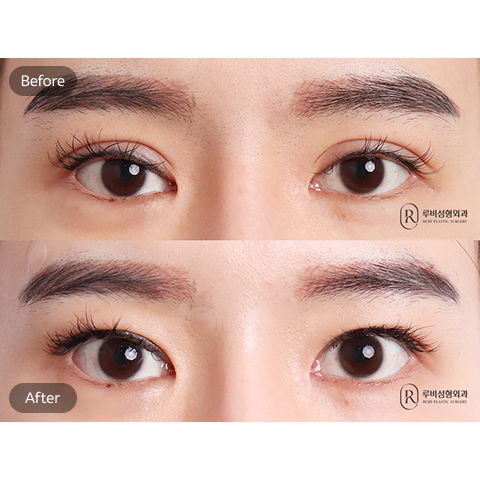 Plastic Surgery Recovery Timeline at 2 Months Showing Natural Appearance and Return to Daily Activities