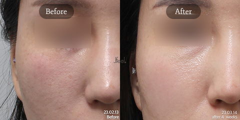Skin Texture and Glass Skin Improvement From Rejuran PDRN Injection Compared With Exosome Therapy in Korean Dermatology