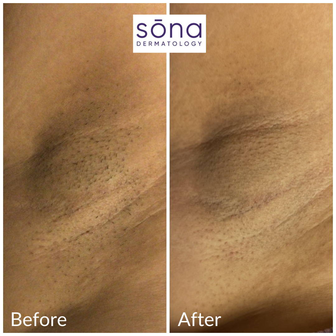 Sona Motus AY Laser Hair Removal Before & After 6