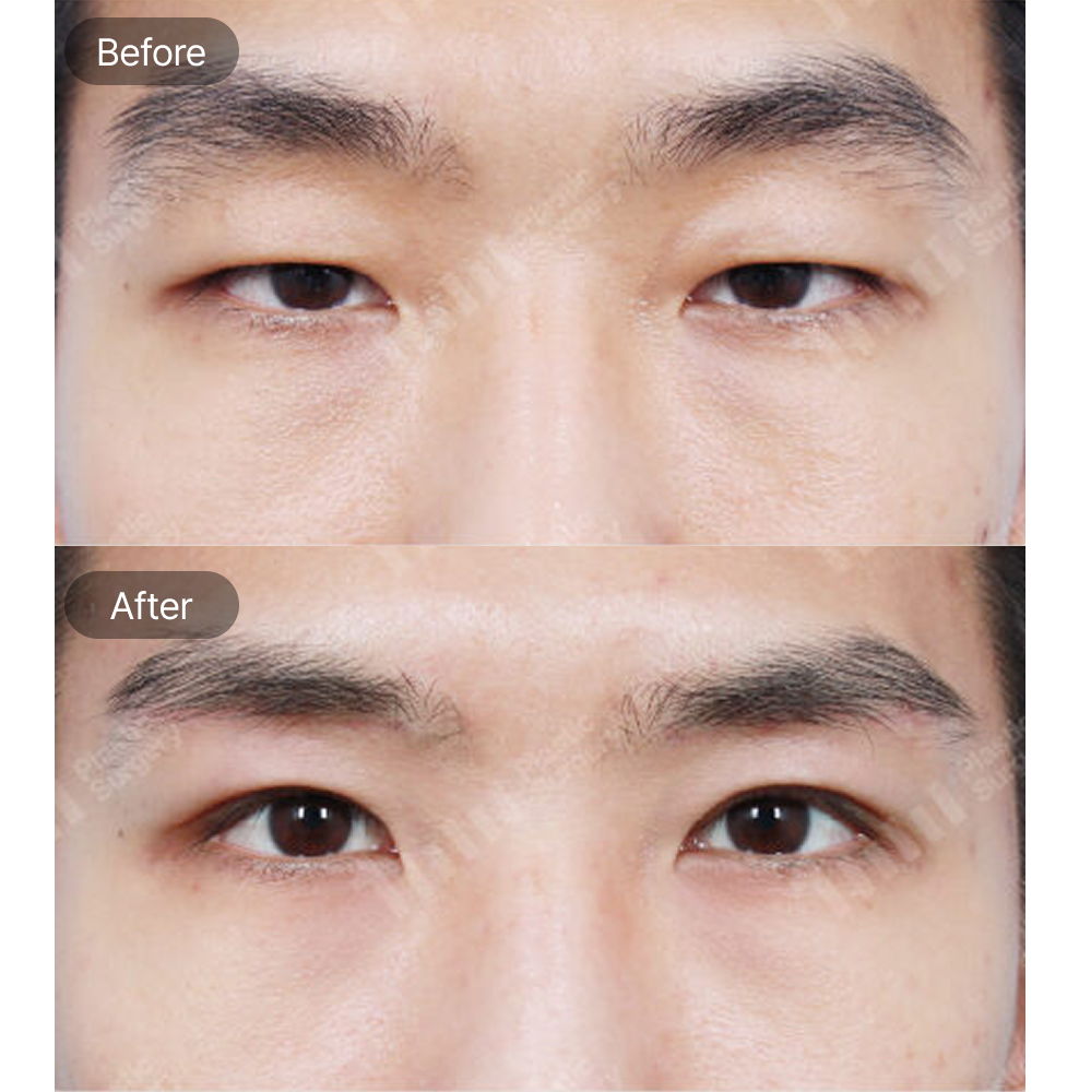 Male Brow Lift Surgery Before and After Results at 1MM Plastic Surgery in Korea for Brighter and More Defined Eyes