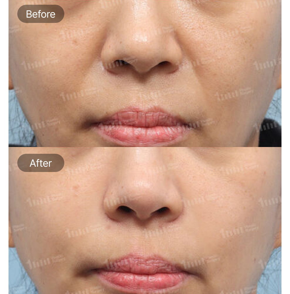 Nasolabial Fold Filler Before and After Results at 1MM Plastic Surgery in Korea for Smoother and More Youthful Smile Lines