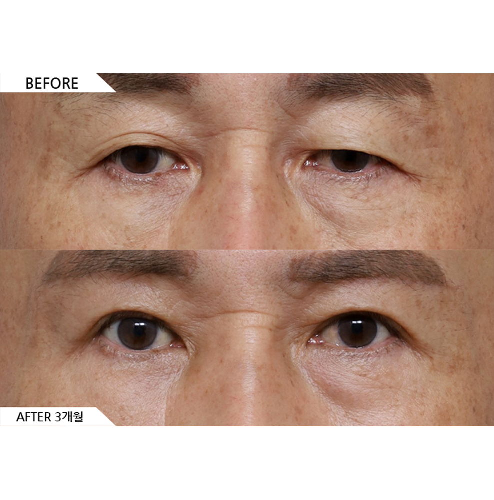 Before and after brow lift surgery in a middle-aged patient showing lifted eyebrows, improved droopy eyelids, and a more youthful eye appearance 3 months after surgery in Korea