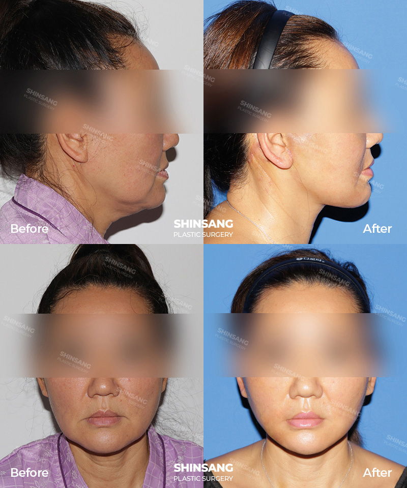 Toad Neck Surgery Neck Reduction Before And After Result At Sinsang Plastic Surgery In Korea
