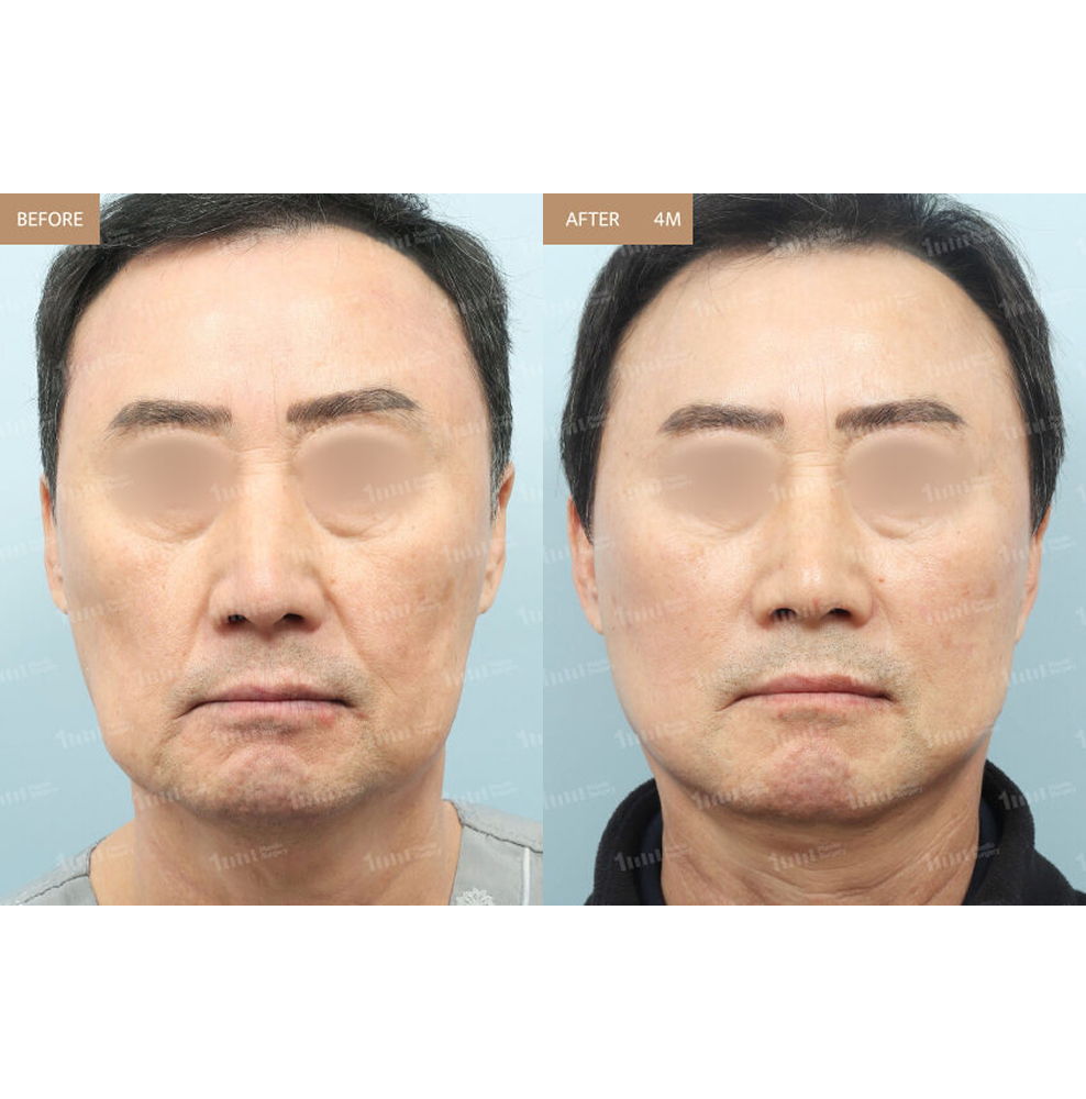 Male Mini Facelift Before and After Results at 1MM Plastic Surgery in Korea for Firmer and More Youthful Facial Contours