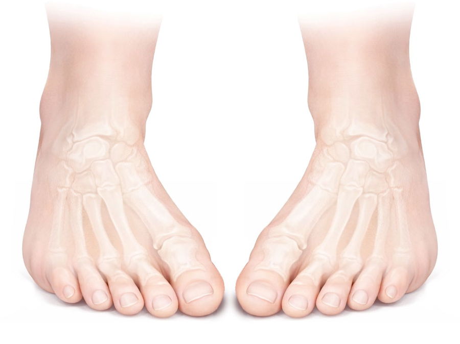Intoeing gait — adducted foot progression angle during walking