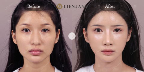 Cheekbone Reduction, Square Jaw Surgery, and Chin Correction Before and After in Korea Showing Refined Facial Contours, Improved Symmetry, and V-Line Facial Shape
