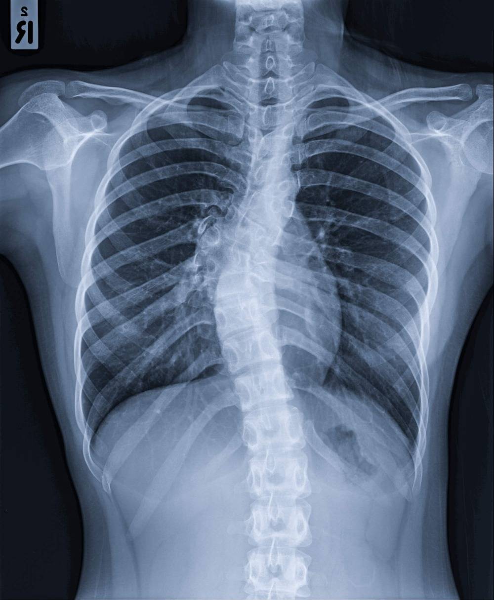 scoliosis thoracic mid bad pain