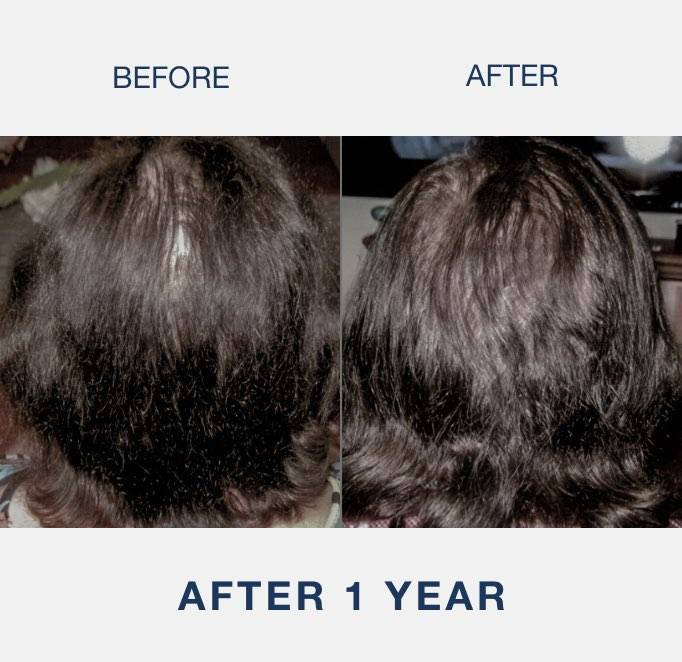 before and after laser cap results from woman with androgenic alopecia