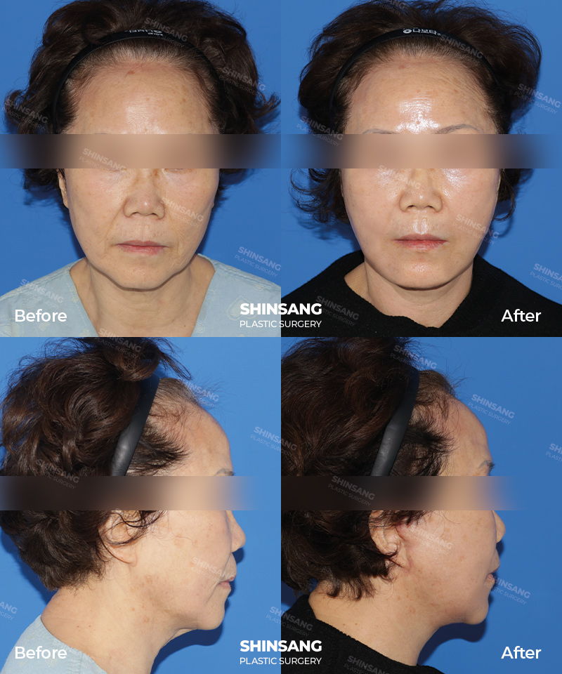 Full Facelift Before And After Result At Sinsang Plastic Surgery In Korea