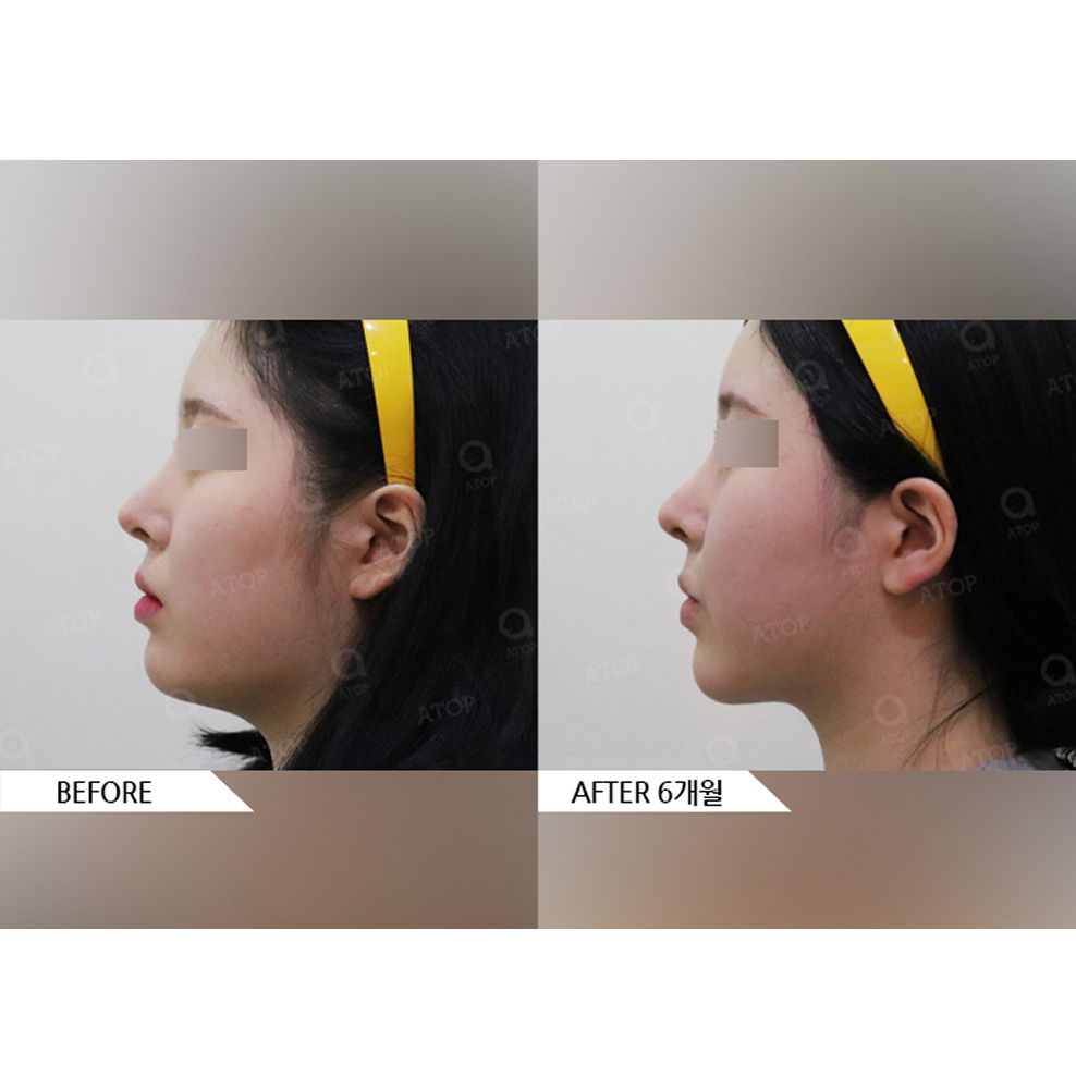 Before and after results of cheekbone reduction surgery showing a slimmer face shape and improved side profile in Korea