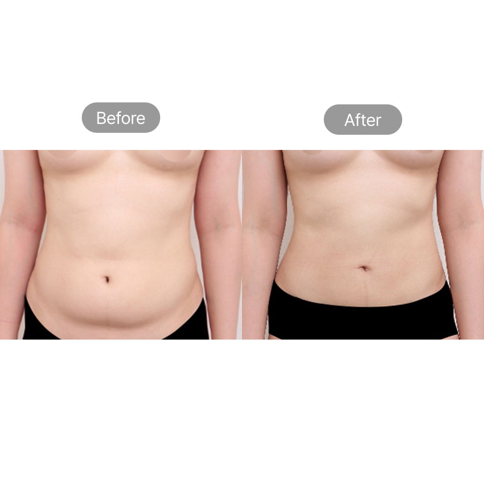 Body liposuction before and after results for abdominal and waistline contouring in Korea