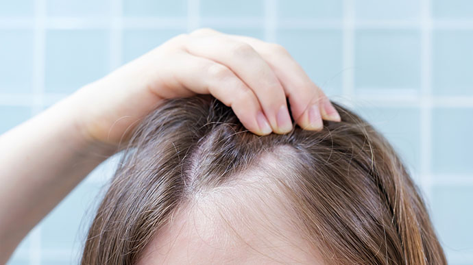 hair loss treatment receding hairline