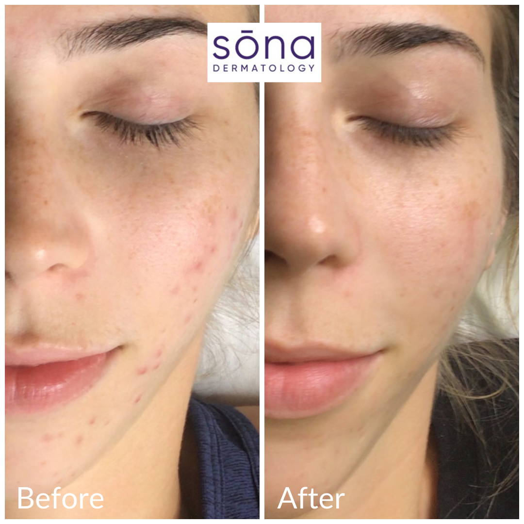 Sona DiamondGlow Facial Before & After 7