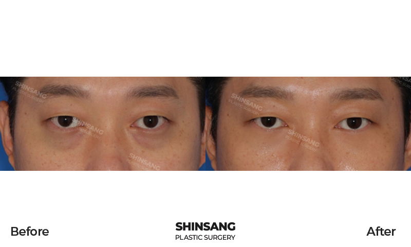Under Eye Fat Repositioning Result At Sinsang Plastic Surgery In Korea