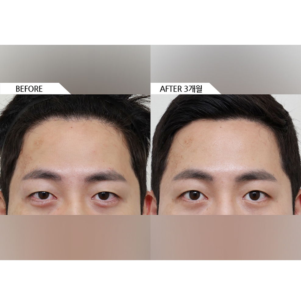 Before and after results of male forehead lift surgery showing lifted brows and a more refreshed appearance 3 months after surgery in Korea