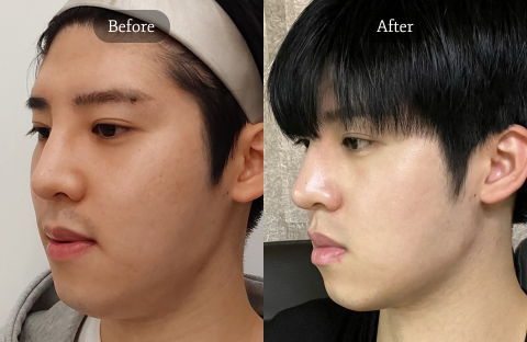Male Plastic Surgery in Korea Featuring Thread Lifting for Natural Jawline Tightening and Youthful Facial Contouring